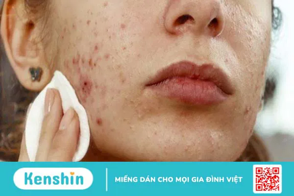 Có nên tẩy tế bào chết cho da mụn không và các lưu ý khi thực hiện