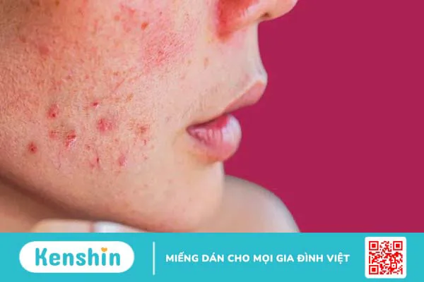 Da nhạy cảm là gì? Cách chăm sóc da nhạy cảm đúng cách và các lưu ý