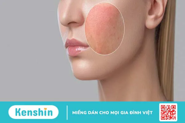 Da nhạy cảm là gì? Cách chăm sóc da nhạy cảm đúng cách và các lưu ý