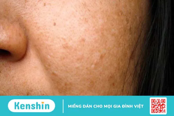 Da nhiễm chì là gì? 5 dấu hiệu và cách điều trị da nhiễm chì