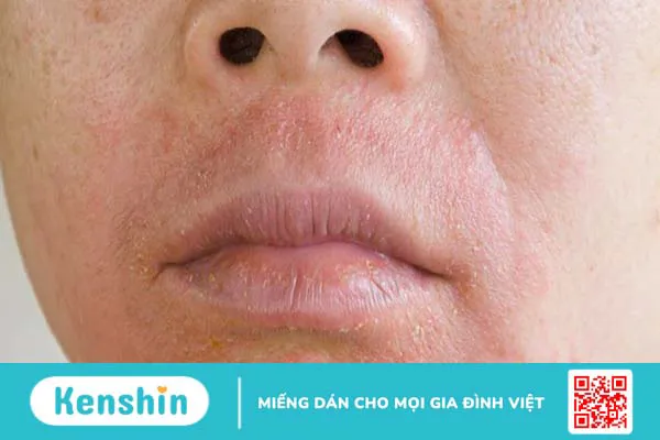 Da nhiễm chì là gì? 5 dấu hiệu và cách điều trị da nhiễm chì