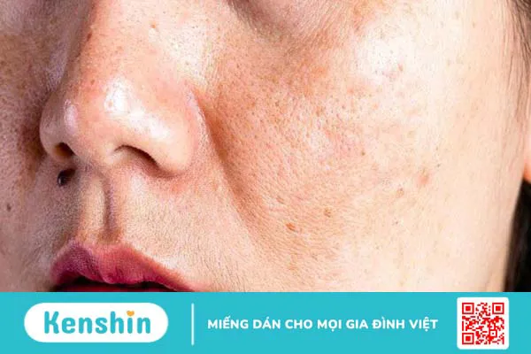 Da nhiễm chì là gì? 5 dấu hiệu và cách điều trị da nhiễm chì