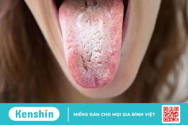 Đắng miệng là bệnh gì? 14 nguyên nhân điển hình của đắng miệng