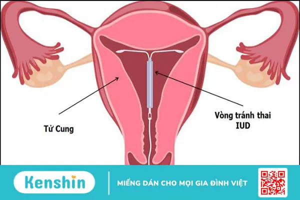 Đặt vòng tránh thai là gì, có mấy loại? Sau bao lâu thì quan hệ được