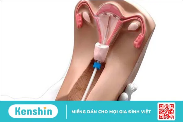 Đặt vòng tránh thai là gì, có mấy loại? Sau bao lâu thì quan hệ được