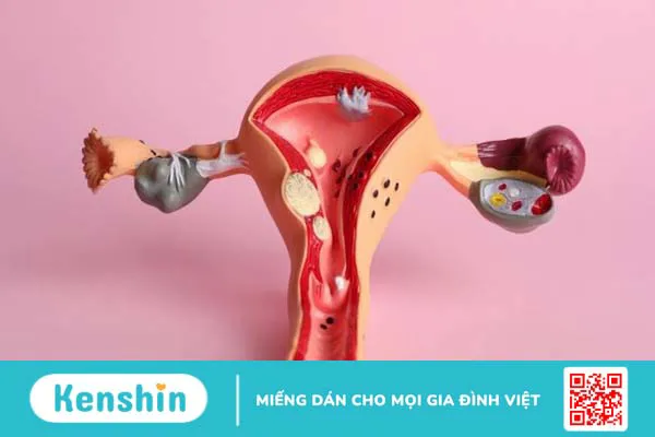 Đau bụng dưới ở phụ nữ: cảnh báo 19 nguyên nhân không thể xem thường