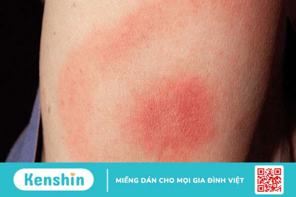 Đau đầu sau tiêm vắc-xin Covid-19 phải làm sao?