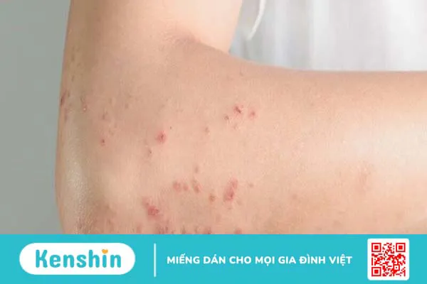 Đau đầu sau tiêm vắc-xin Covid-19 phải làm sao?