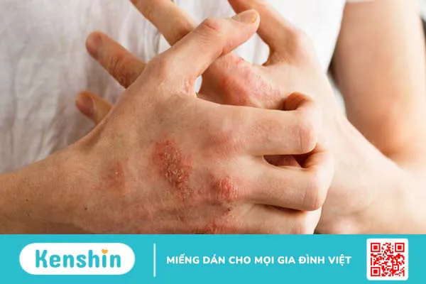 Dầu hạt lanh là gì? Lợi ích cho sức khoẻ của dầu hạt lanh