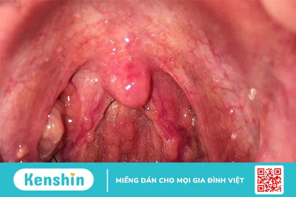 Dấu hiệu bệnh tay chân miệng thường gặp ở trẻ em và người lớn là gì?