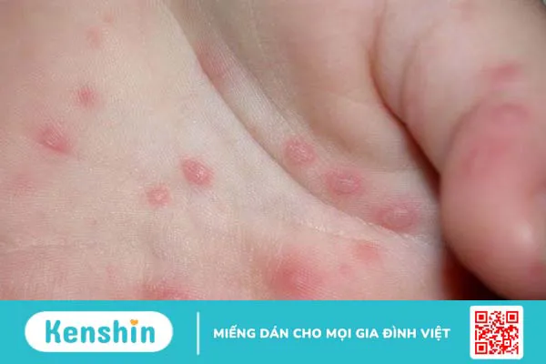 Dấu hiệu bệnh tay chân miệng thường gặp ở trẻ em và người lớn là gì?