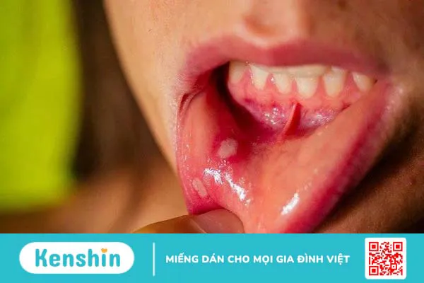 Dấu hiệu bệnh tay chân miệng thường gặp ở trẻ em và người lớn là gì?