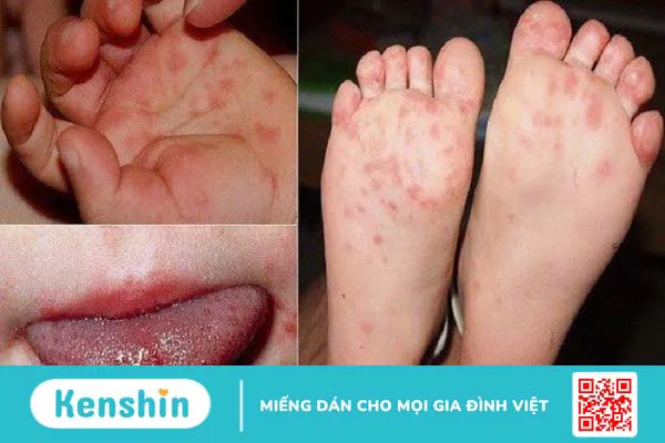 Dấu hiệu bệnh tay chân miệng thường gặp ở trẻ em và người lớn là gì?