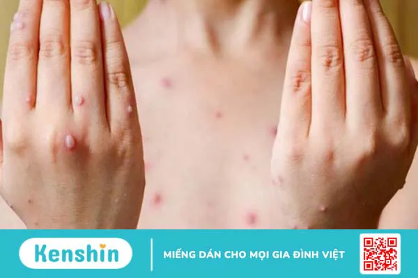 Dấu hiệu bệnh thủy đậu bạn cần biết để điều trị bệnh sớm