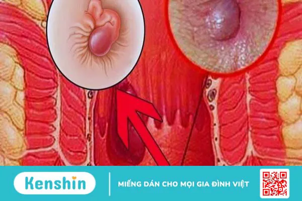 Dấu hiệu bệnh trĩ ở phụ nữ và cách điều trị hiệu quả