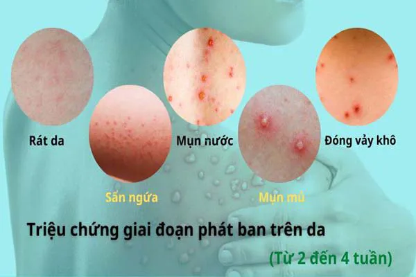 Dấu hiệu đậu mùa khỉ giúp bạn nhận biết bệnh chính xác