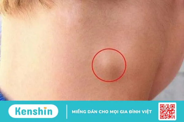 Dấu hiệu HIV sớm theo từng giai đoạn giúp điều trị hiệu quả