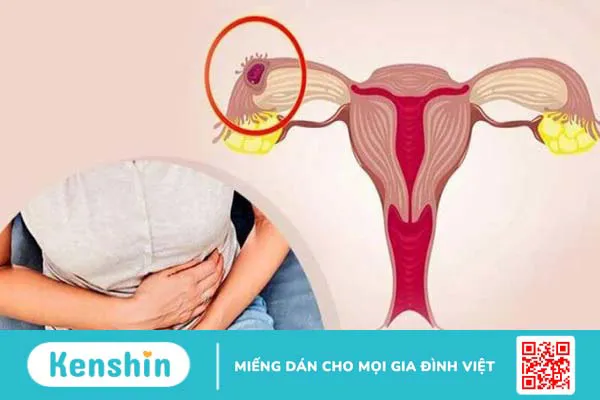 Dấu hiệu mang thai ngoài tử cung sớm nhất thai phụ nên chú ý