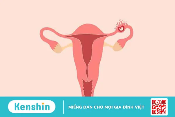 Dấu hiệu mang thai ngoài tử cung sớm nhất thai phụ nên chú ý