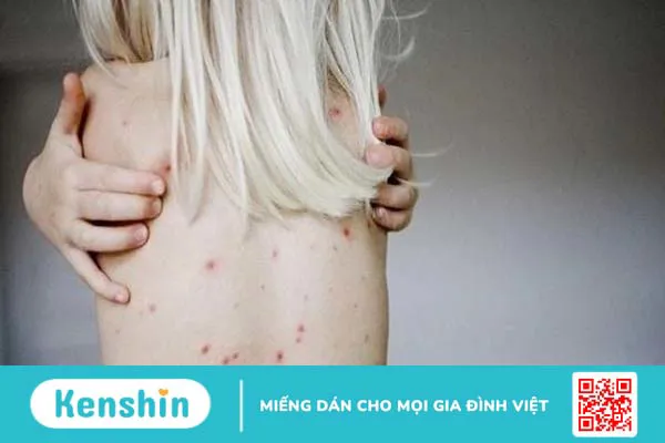 Dấu hiệu nhận biết bệnh giang mai sớm nhất qua các giai đoạn bệnh