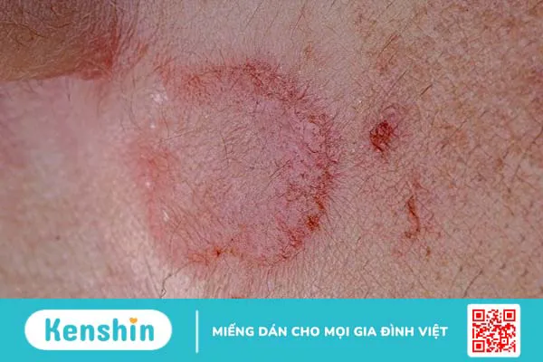 Dấu hiệu nhận biết bệnh giang mai sớm nhất qua các giai đoạn bệnh