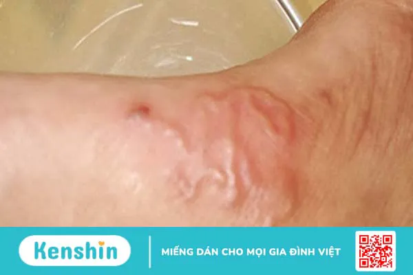 Dấu hiệu nhận biết và chẩn đoán chính xác bị nhiễm sán lợn