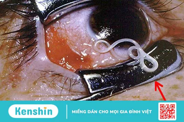 Dấu hiệu nhận biết và chẩn đoán chính xác bị nhiễm sán lợn