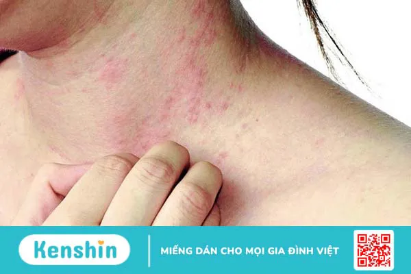 Dấu hiệu nhận biết và chẩn đoán chính xác bị nhiễm sán lợn