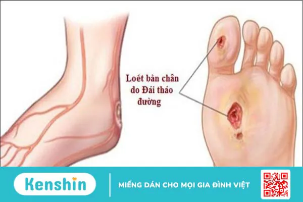 Dấu hiệu ở chân cảnh báo bệnh tiểu đường: Cách nhận biết và phòng ngừa