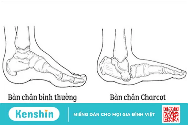 Dấu hiệu ở chân cảnh báo bệnh tiểu đường: Cách nhận biết và phòng ngừa