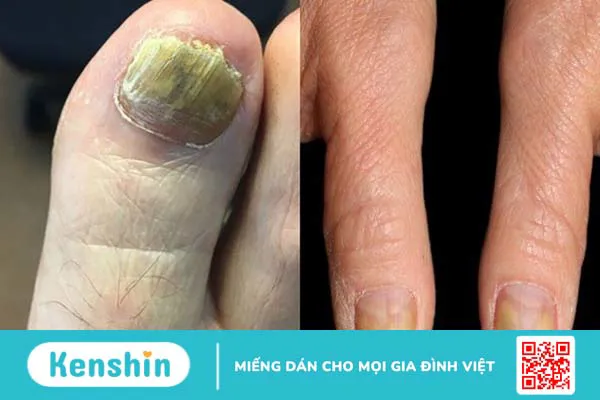 Dấu hiệu ở chân cảnh báo bệnh tiểu đường: Cách nhận biết và phòng ngừa