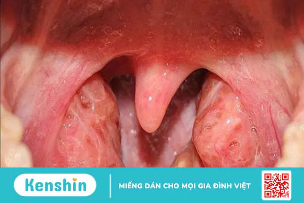 Đau họng 1 bên là bệnh gì? Nguyên nhân gây đau họng 1 bên và giải pháp