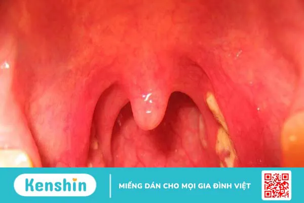 Đau họng 1 bên là bệnh gì? Nguyên nhân gây đau họng 1 bên và giải pháp