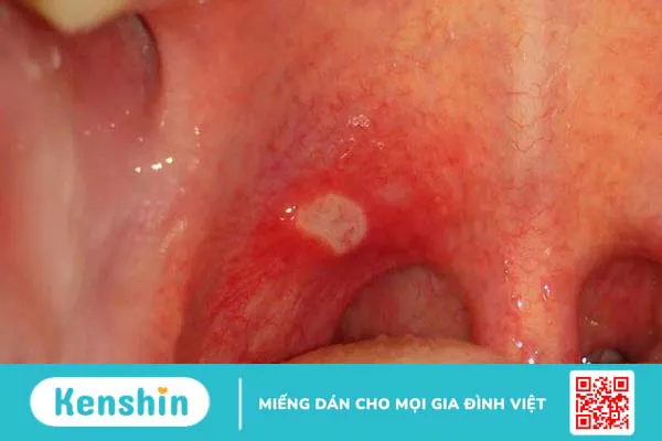 Đau họng 1 bên là bệnh gì? Nguyên nhân gây đau họng 1 bên và giải pháp