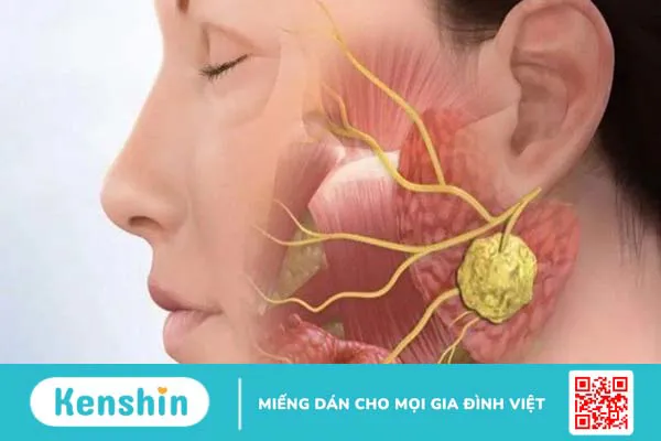 Đau họng 1 bên là bệnh gì? Nguyên nhân gây đau họng 1 bên và giải pháp