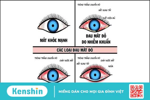 Đau mắt đỏ kiêng gì ăn gì để nhanh khỏi và lưu ý khi chăm sóc mắt