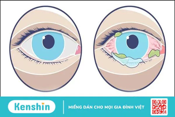 Đau mắt đỏ kiêng gì ăn gì để nhanh khỏi và lưu ý khi chăm sóc mắt