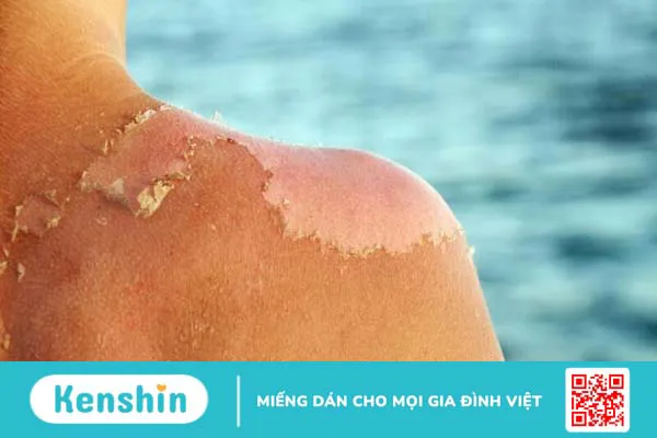 Dầu mù u có tác dụng gì? Mách bạn 9 tác dụng của dầu mù u