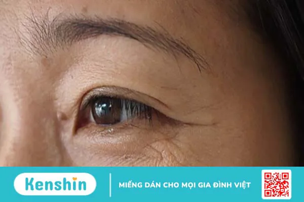 Dầu mù u có tác dụng gì? Mách bạn 9 tác dụng của dầu mù u