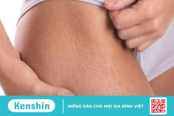 Dầu mù u có tác dụng gì? Mách bạn 9 tác dụng của dầu mù u