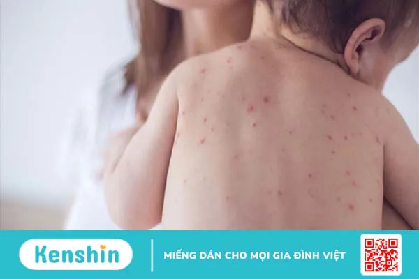 Đậu mùa khỉ lây qua đường nào và các biện pháp phòng ngừa