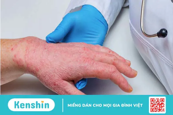 Đậu mùa khỉ lây qua đường nào và các biện pháp phòng ngừa