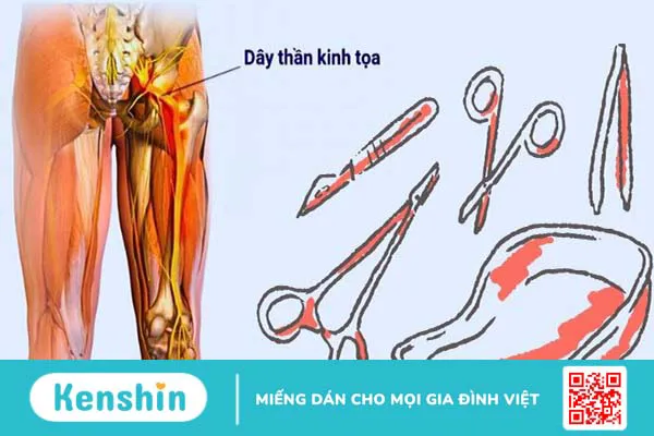 Đau thần kinh tọa uống thuốc gì? 8 thuốc trị hiệu quả theo đơn bác sĩ