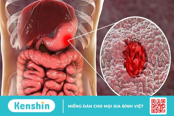 Đau xương khớp có ăn được chuối tiêu không? Lưu ý cần biết