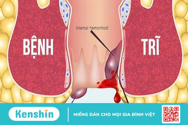 Đi cầu ra máu có thể là biểu hiện của 13 bệnh gì? Xem ngay