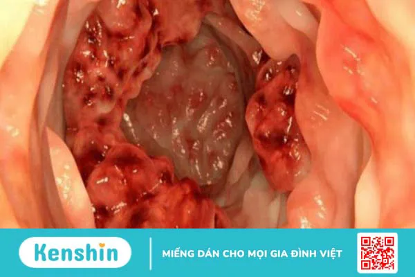 Đi cầu ra máu có thể là biểu hiện của 13 bệnh gì? Xem ngay