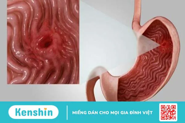 Đi cầu ra máu có thể là biểu hiện của 13 bệnh gì? Xem ngay