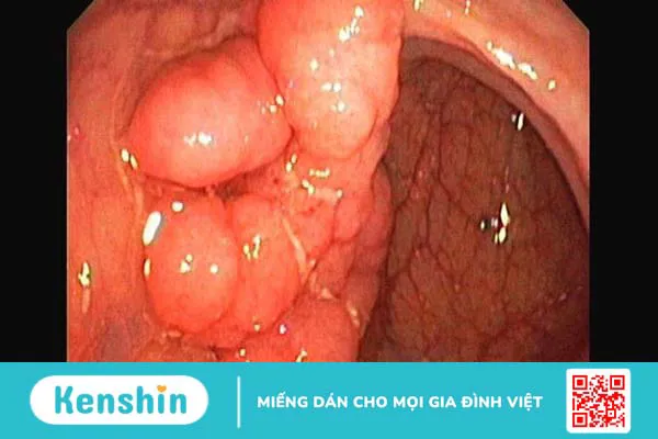 Đi cầu ra máu có thể là biểu hiện của 13 bệnh gì? Xem ngay