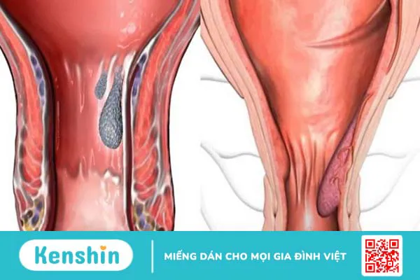 Đi cầu ra máu có thể là biểu hiện của 13 bệnh gì? Xem ngay