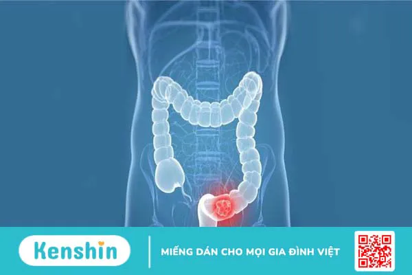 Đi cầu ra máu có thể là biểu hiện của 13 bệnh gì? Xem ngay